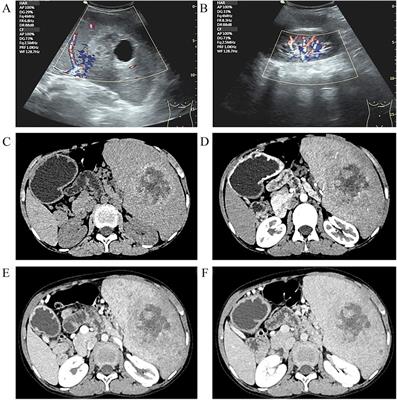 Littoral cell angioma of a huge spleen with peripheral blood pancytopenia in a 14-year-old boy: a case report and review of the literature